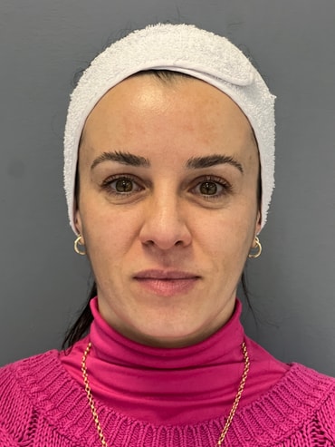 Fer antes do preenchimento de olheiras + bioestímulo de colágeno